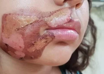 CRIANÇA TEM ROSTO QUEIMADO PELA MÃE COM COLHER NO RJ