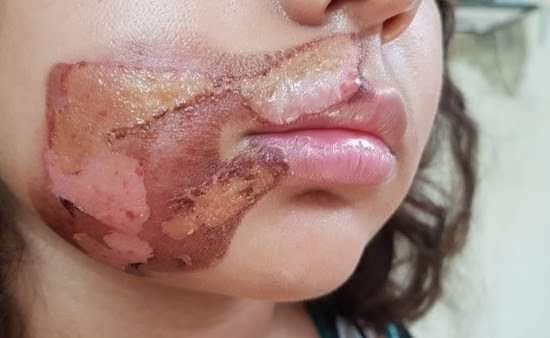CRIANÇA TEM ROSTO QUEIMADO PELA MÃE COM COLHER NO RJ