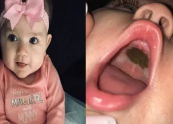 Médicos diziam que marca escura na boca da bebê era de nascença, mas mãe sabia que não era