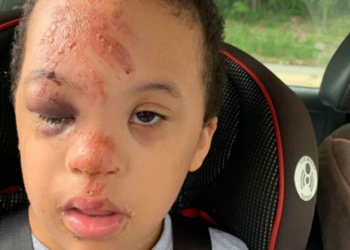 Menino com síndrome de Down chega assim da escola e mãe desabafa