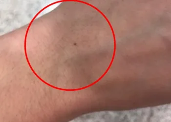Você tem uma pinta próxima ao pulso? Saiba o que isso significa