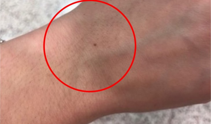 Você tem uma pinta próxima ao pulso? Saiba o que isso significa