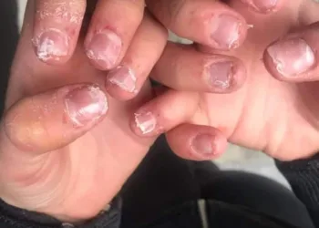 DESASTRE COM UNHAS DE ACRÍLICO DEIXA JOVEM ‘SANGRANDO E COM DOR’