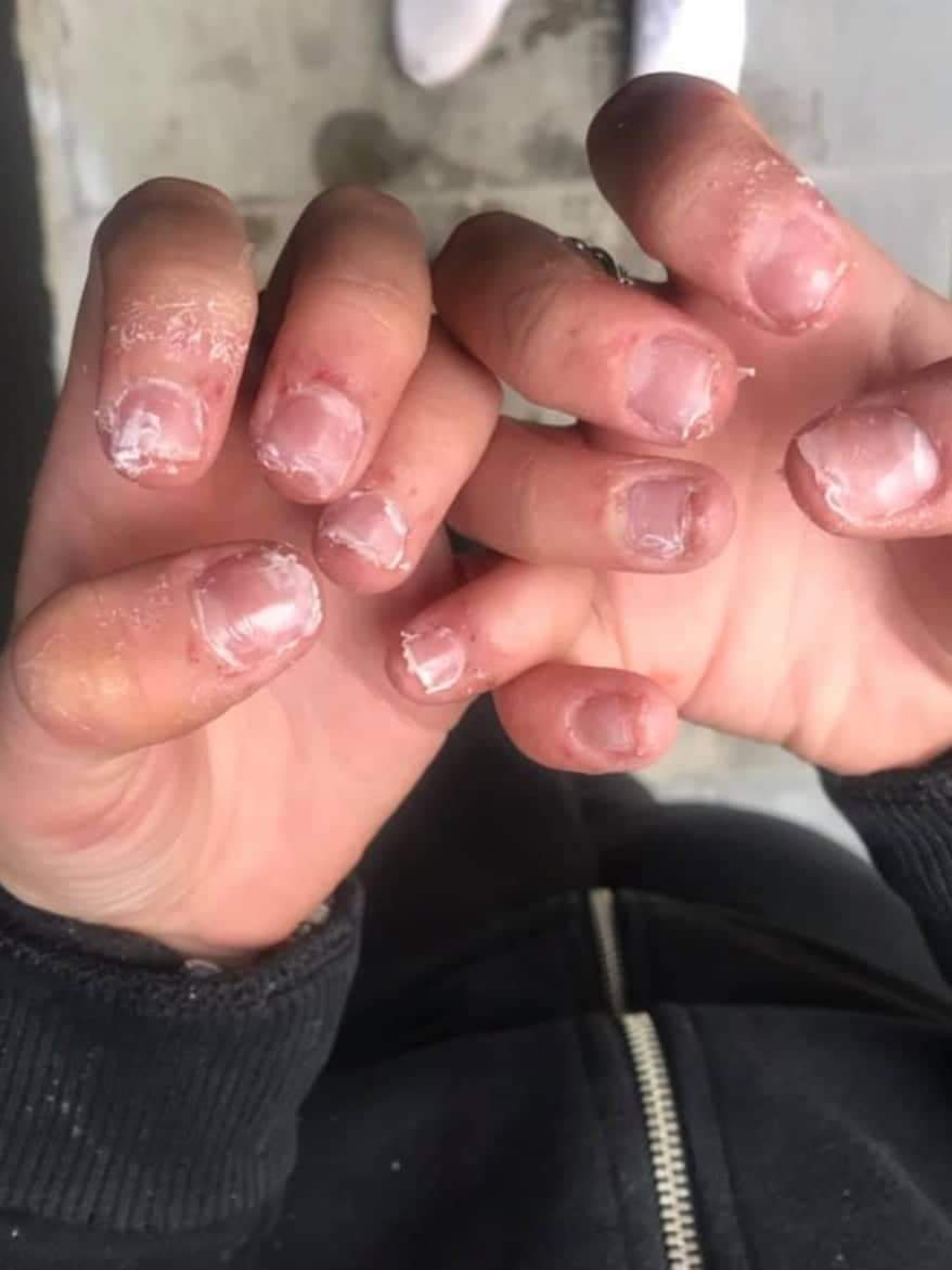 DESASTRE COM UNHAS DE ACRÍLICO DEIXA JOVEM ‘SANGRANDO E COM DOR’