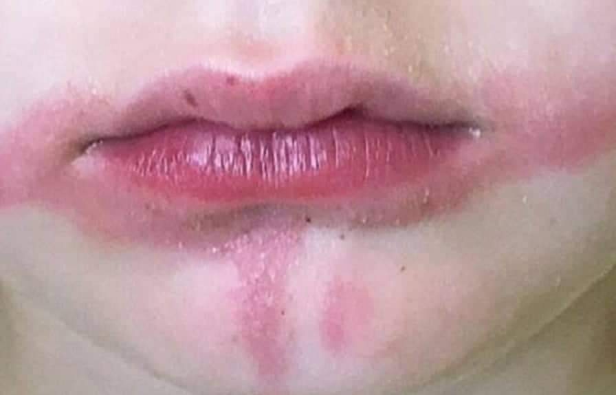 Criança sofre grave queimadura na boca após comer picolé; entenda os riscos
