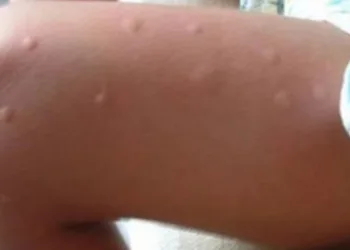 Os mosquitos sempre atacam você? Aqui está o motivo disso acontecer