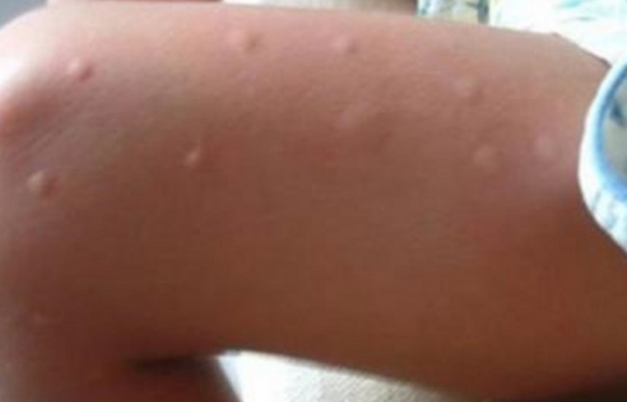Os mosquitos sempre atacam você? Aqui está o motivo disso acontecer