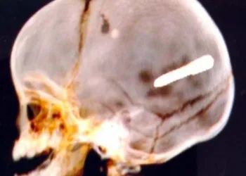 Bebê de 10 meses é atingido por “prego” na cabeça em paciencia