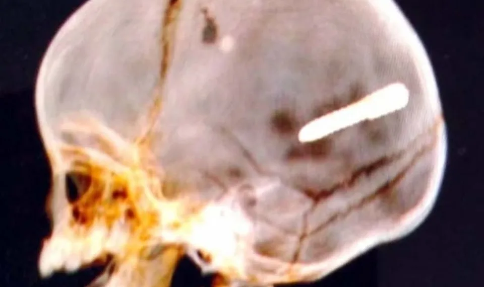 Bebê de 10 meses é atingido por “prego” na cabeça em paciencia