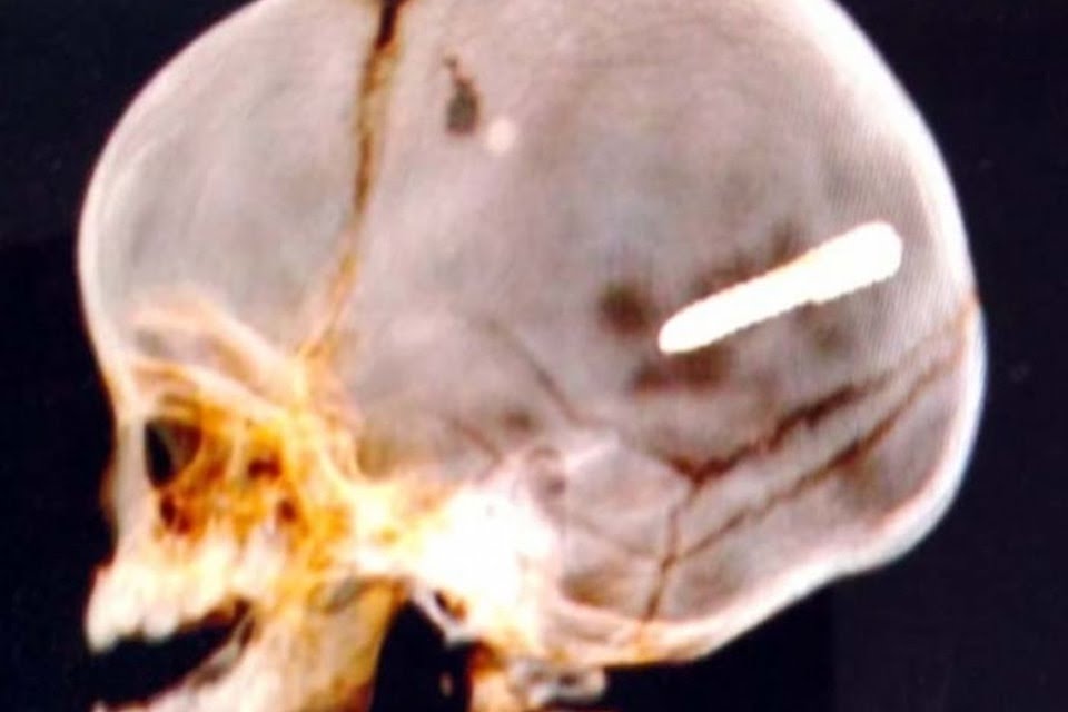 Bebê de 10 meses é atingido por “prego” na cabeça em paciencia