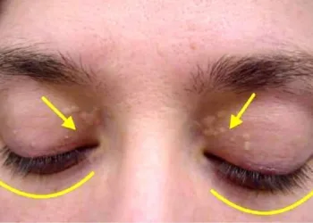 Se isto aparecer nos seus olhos tenha atenção; o motivo é assustador e pode ser fatal