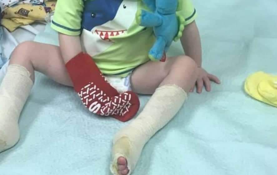 Pés de menino quase derretem em parque aquático e pai faz alerta