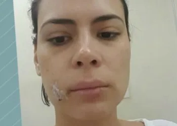 Apresentadora da Rede Globo leva 20 pontos no rosto após ser atacada por um cão