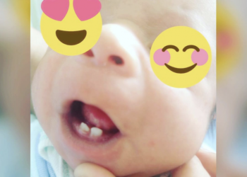 Caso raro: bebê nasce com dois dentes no interior de São Paulo