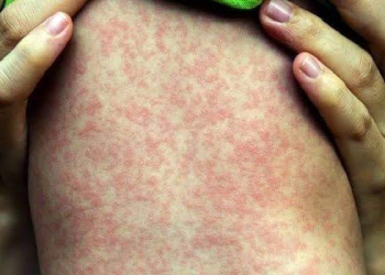 ESTADO DO RIO ENTRA EM ALERTA CONTRA O SARAMPO