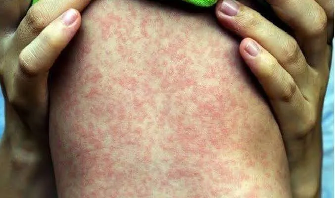 ESTADO DO RIO ENTRA EM ALERTA CONTRA O SARAMPO