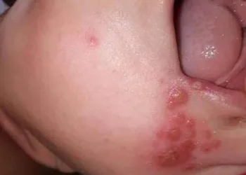 ALERTA!! MINHA FILHA TEM 7 MESES E PEGOU HERPES