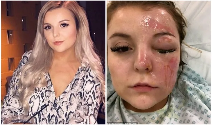 Mulher fica cega ao cozinhar ovos no microondas