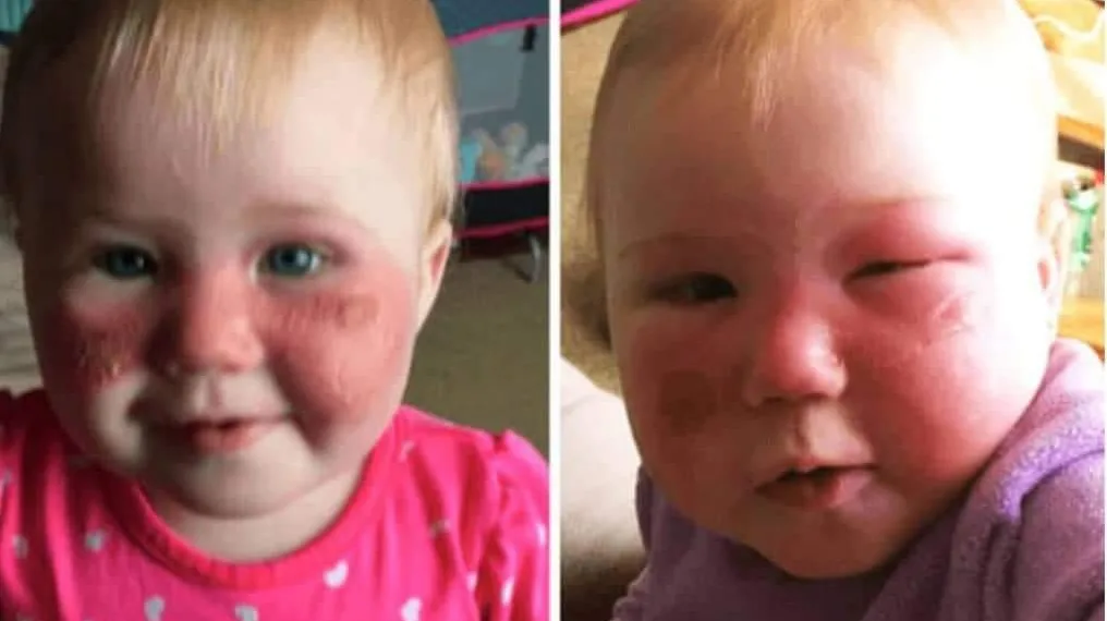 Mãe se desespera após bebê ficar queimado com produto infantil muito comum