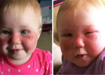 Mãe se desespera após bebê ficar queimado com produto infantil muito comum