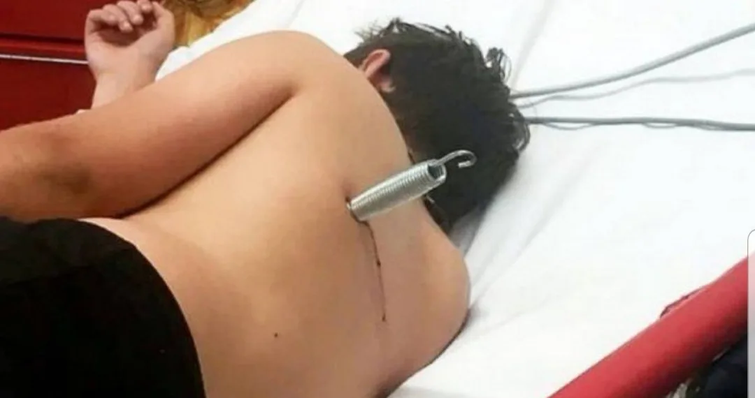 H! Mola de cama elástica vai parar cravada nas costas de adolescente