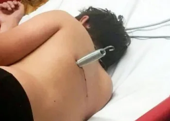 H!  Mola de cama elástica vai parar cravada nas costas de adolescente