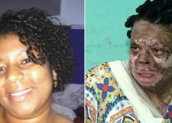 Um ano depois, diarista queimada pelo ex ainda faz tratamento: ‘Eu não tenho ódio dele’, afirma
