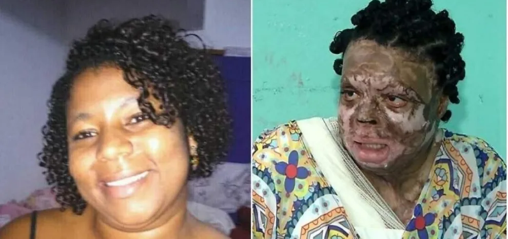 Um ano depois, diarista queimada pelo ex ainda faz tratamento: ‘Eu não tenho ódio dele’, afirma