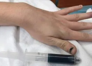 MULHER FICA COM O SANGUE AZUL APÓS TOMAR REMÉDIO PARA DOR DE DENTE