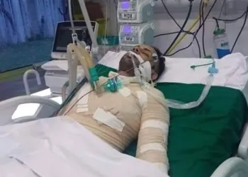 MORRE JOVEM QUE FOI QUEIMADO PELA EX NAMORADA NO RJ