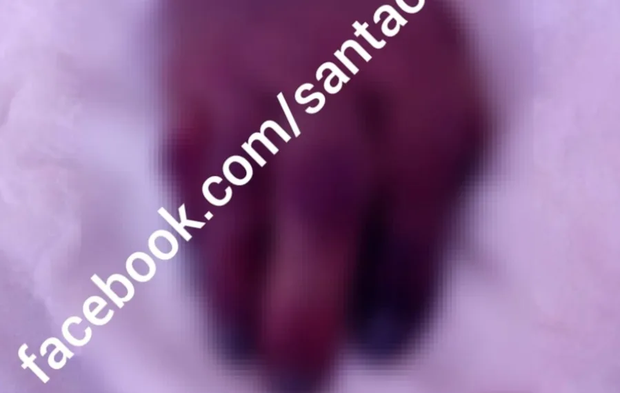 DENÚNCIA!!Paciente terá mão amputada no Hospital Pedro II por negligência”, conta família