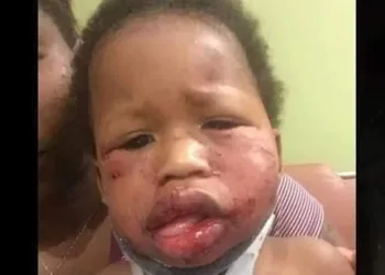 Menino é agredido na creche, mãe mostra machucados e desabafa