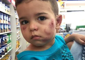Mãe registra ocorrência após bebê de 1 ano ser entregue pela creche com marcas de mordida.