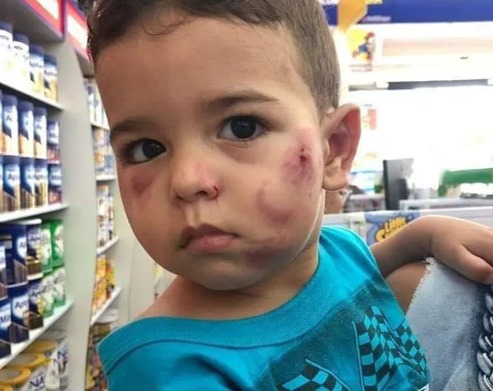 Mãe registra ocorrência após bebê de 1 ano ser entregue pela creche com marcas de mordida.