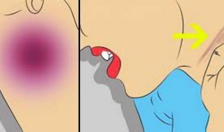 Estes sinais se parecem com uma simples anemia, mas são sintomas de grave leucemia