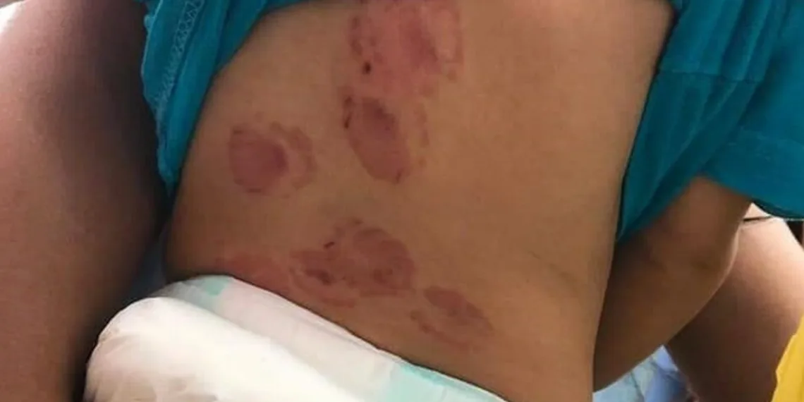 Absurdo! Bebê de 1 ano volta de creche com 15 mordidas e diretora conta como isso aconteceu