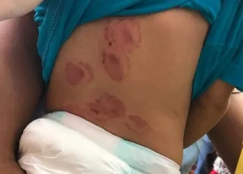 Absurdo! Bebê de 1 ano volta de creche com 15 mordidas e diretora conta como isso aconteceu