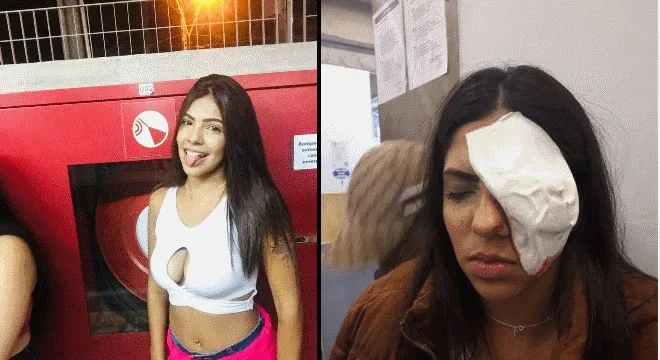 Operação da PM em baile funk deixa jovem cega com bala de borracha