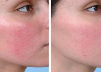 Se seu rosto fica vermelho ao beber, você pode estar com terrível doença