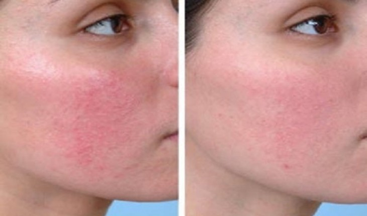 Se seu rosto fica vermelho ao beber, você pode estar com terrível doença