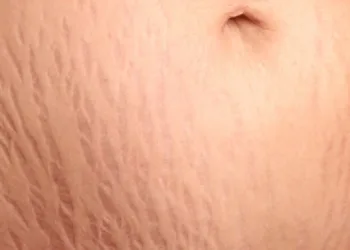 Saiba como remover as estrias do seu corpo usando aspirina