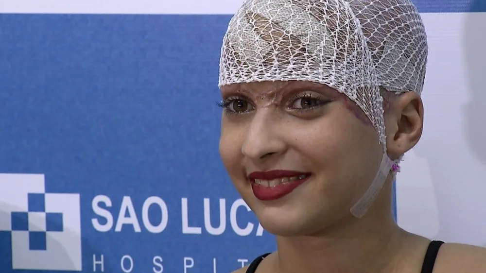 ‘Eu ganhei muito mais do que perdi’, diz jovem que teve couro cabeludo arrancado em acidente com kart no Recife