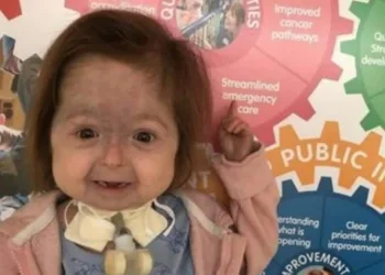 Menina é a única no mundo a ter a doença de Benjamin Button