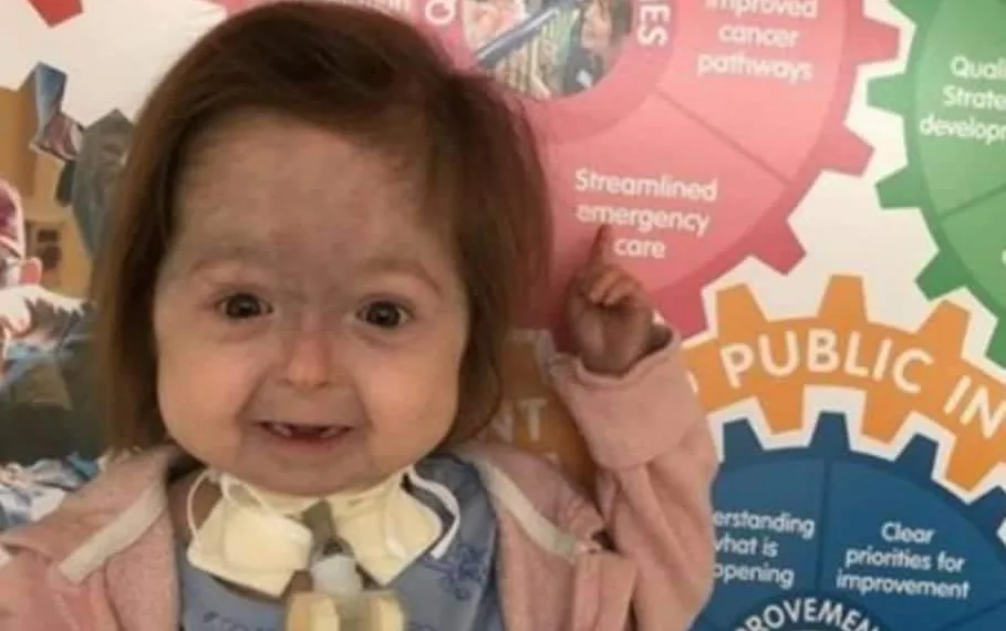 Menina é a única no mundo a ter a doença de Benjamin Button