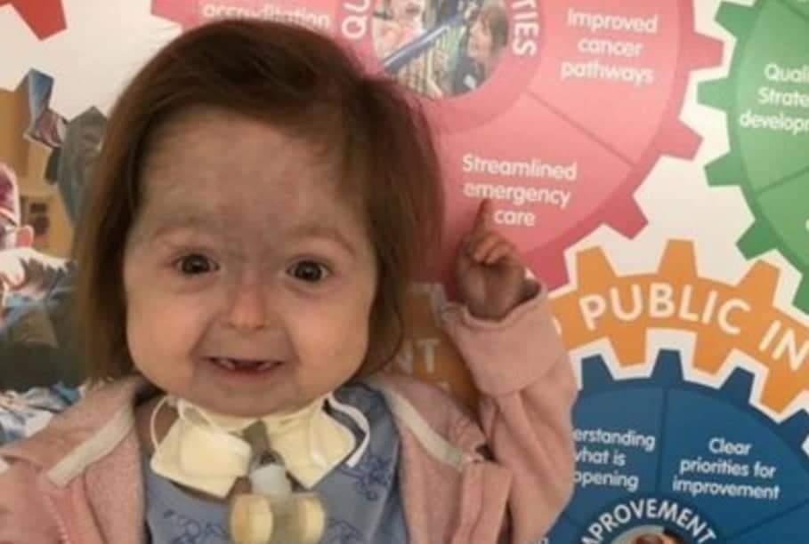 Menina é a única no mundo a ter a doença de Benjamin Button