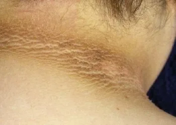 Especialista alerta sobre marca escura em volta do pescoço; cuidado, pode indicar grave doença