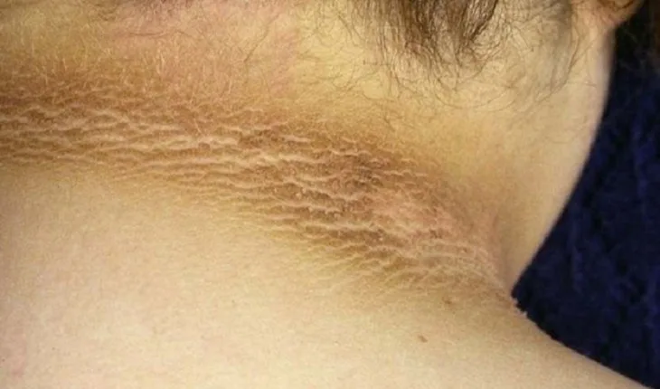 Especialista alerta sobre marca escura em volta do pescoço; cuidado, pode indicar grave doença