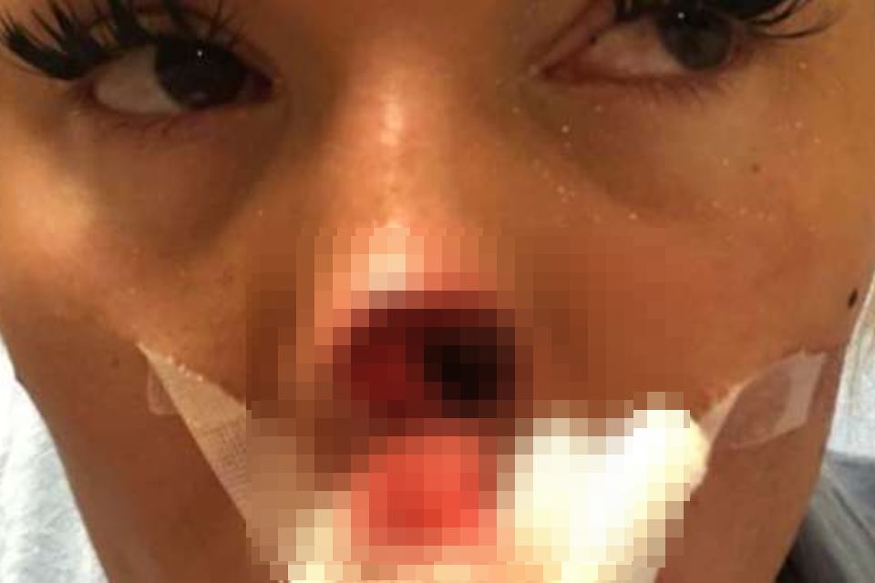 Homem morde e arranca pedaço de nariz da namorada durante briga( imagens fortes)