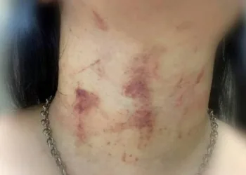 Jovem é enforcada pelo ex-companheiro durante série de agressões no Rio