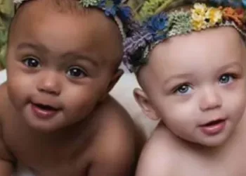 Confira as fotos das gêmeas de cores diferentes depois de adultas